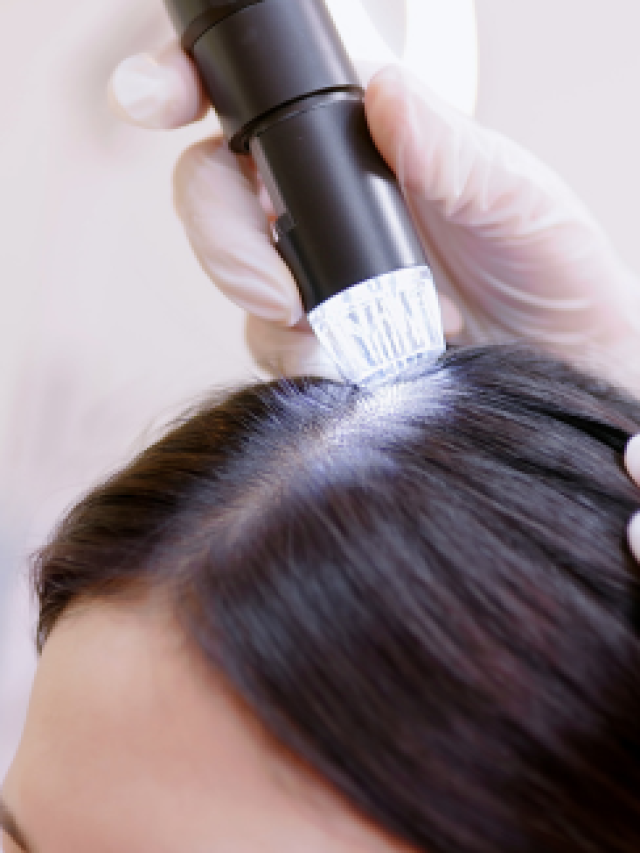 Hair Loss Treatement
