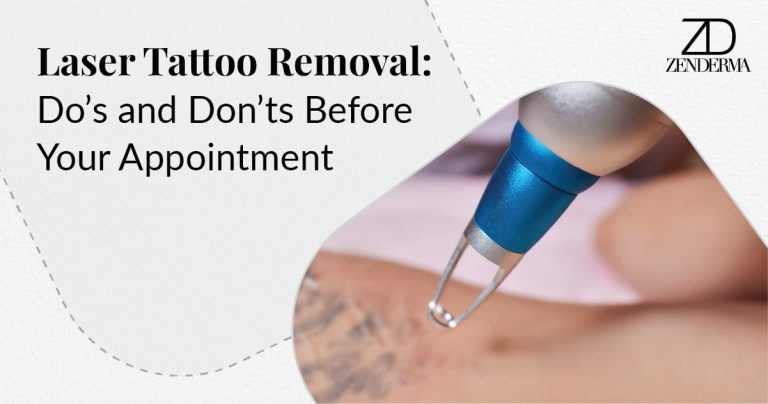 dos donts of laser tattoo removal