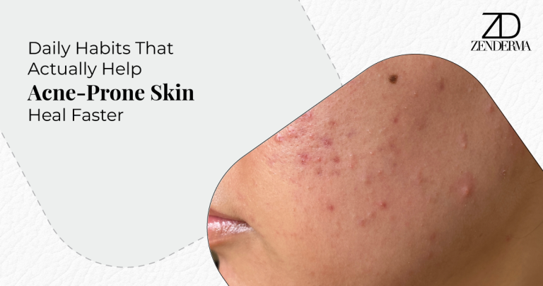 Daily Habits That Actually Help Acne-Prone Skin Heal Faster