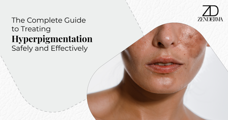Guide to Treating Hyperpigmentation