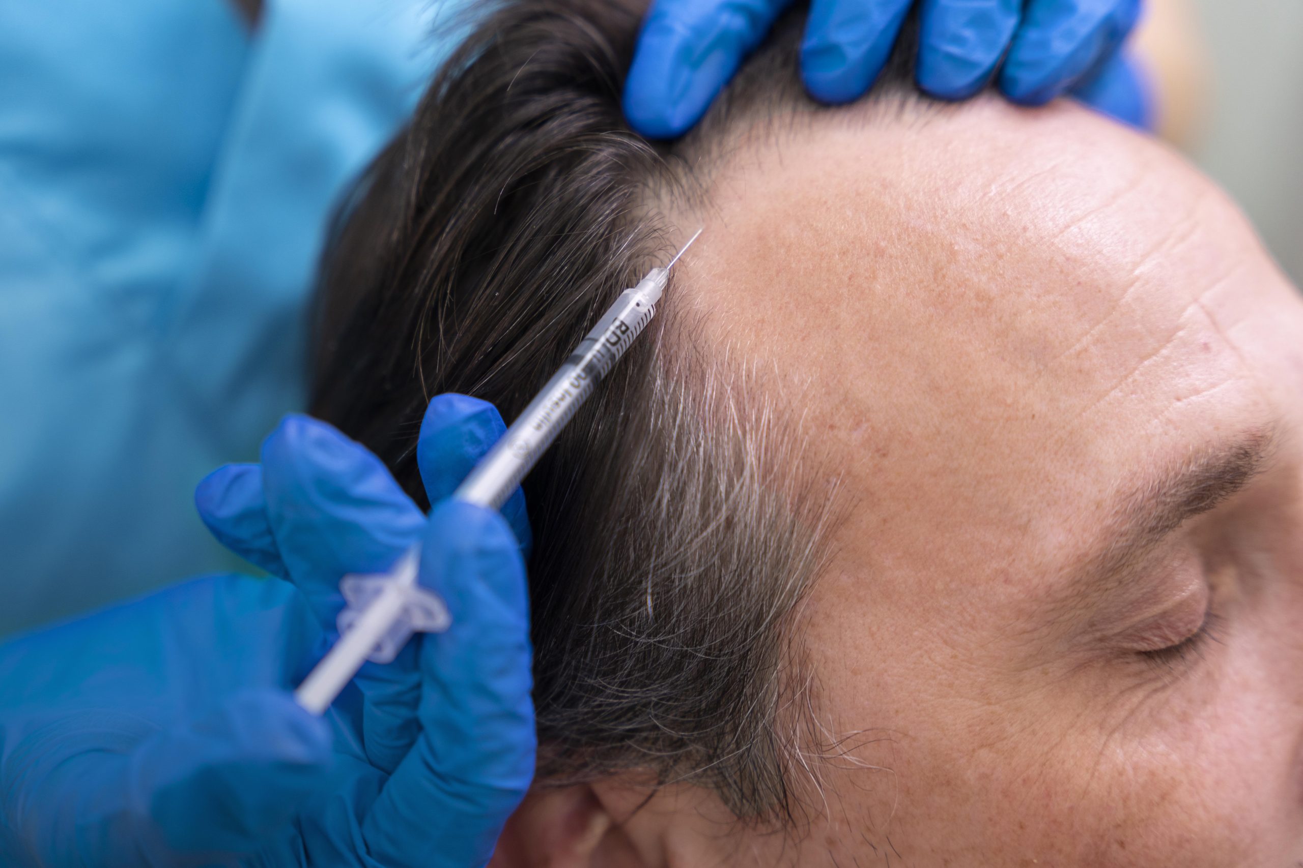 Adult male gets exorenew scalp reset treatment