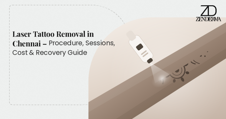 Laser Tattoo Removal in Chennai – Procedure, Sessions, Cost & Recovery Guide